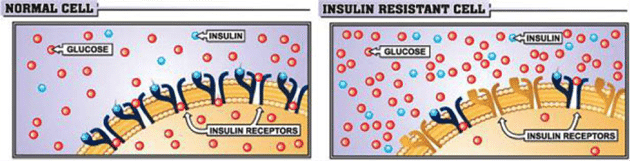 insulin-resistant-cell